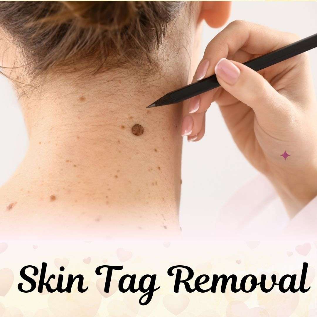 skin-tag-r_17302795373DK6bo.jpeg